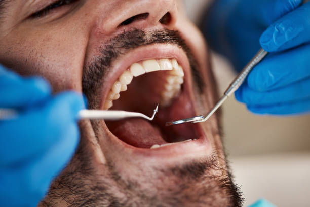 Best Emergency Dental Extractions in Martinsville, VA
